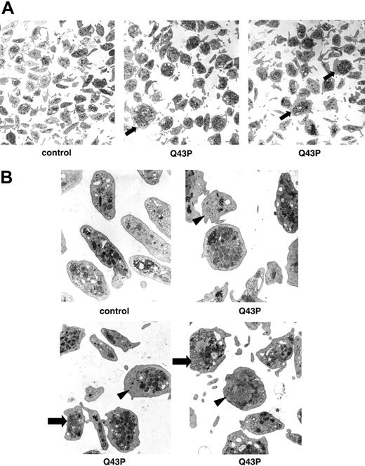 Figure 2. Ultrastructural analysis of platelets. (A) Electron microscopy of platelets (original magnification, × 7800) of a healthy individual and 2 heterozygous β1-tubulin Q43P carriers (carriers 1 and 2). Almost 50% of Q43P carrier platelets are enlarged and round (arrow). (B) Electron microscopy of platelets (original magnification, × 22 500) of a healthy individual and 3 heterozygous β1-tubulin Q43P carriers, showing cytoplasmic inclusions composed of smooth endoplasmic reticulum and abnormal membrane complexes (arrow). Note also the organelle-free zones in some platelets (arrowhead). There is a normal number of more centralized platelet alpha and dense granules.