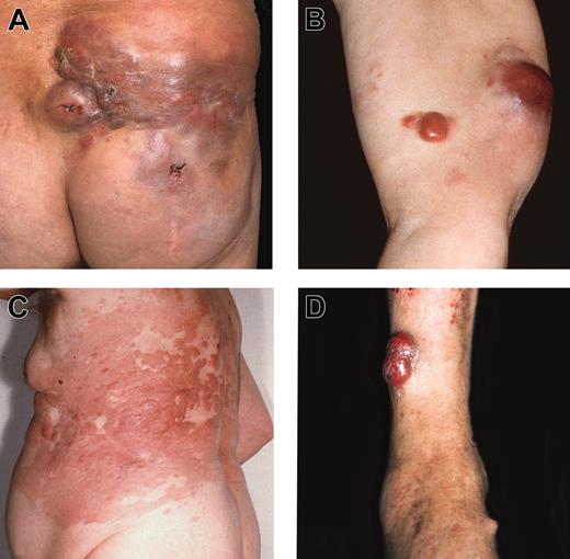 Figure 1. Various clinical features of FCLDT. (A) Multiple red-brown plaques and large tumors on the lower back and buttock; (B) 2 distinct reddish tumors on the upper arm; (C) confluent erythematous plaques and flat tumors involving large part of the trunk (“Crosti lymphoma”); (D) confluent reddish tumors on the lower leg.