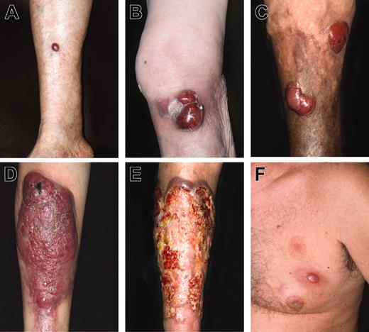 Figure 2. Different morphologic expressions of LBCLLT. (A) Small solitary tumor on the lower leg; (B) confluent large tumors on knee; (C) distinct large tumors on the lower leg on the background of chronic venous insufficiency; (D) large tumor involving almost the entire frontal aspect of the lower leg; (E) large ulcerated lesion involving almost the entire lower leg; (F) erythematous tumor and small plaque on the chest.