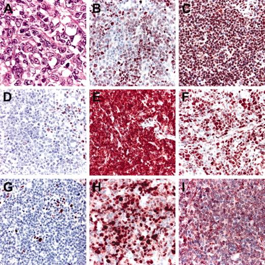Figure 3. Histopathologic features and phenotypic variations of FCLDT. (A) Large cleaved cells predominate; (B) variable, weak expression of FOX-P1; (C) strong, uniform expression of FOX-P1; (D) negativity for Bcl-2; please note internal positive controls; (E) strong positivity for Bcl-2; (F) positive staining for Bcl-6; (G) staining for MUM-1 showing only scattered positive cells; (H) strong positivity for MUM-1 in the great majority of neoplastic cells; (I) expression of CD10 by the large lymphocytes.