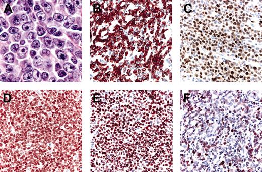 Figure 4. Histopathologic features and phenotypic variations of LBCLLT. (A) Large round cells predominate; (B) strong positivity for Bcl-2; (C) positive staining for Bcl-6; (D) strong, uniform expression of FOX-P1; (E) strong, uniform positivity for MUM-1; (F) staining for MUM-1 showing only a weak expression of the protein.