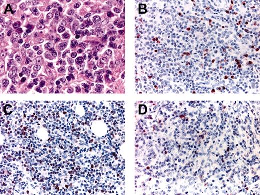 Figure 5. Histopathologic features and phenotypic variations of LBCLO. (A) Large round cells predominate; (B) only a proportion of the large cells are positive for MUM-1; (C) variable expression of Bcl-6 in the majority of neoplastic cells; (D) negative staining for Bcl-2; please note positive internal controls (small lymphocytes).