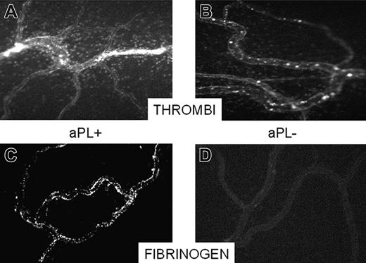 Figure 2. Occlusion of a mesenteric microvessel by thrombi and fibrinogen deposition on the endothelium. Video-photomicrographs of mesenteric microvessels of rats receiving an intraperitoneally injection of LPS and 3 hours later an infusion of either aPL-positive IgG or aPL-negative IgG. The micrographs were taken 30 minutes after the IgG infusion. Thrombi occluding 2 vessels can be seen in the aPL-positive IgG-treated rats (A) and absence of thrombi in the microvessels of aPL-negative IgG-treated rats (B). To evaluate deposition of fibrinogen, the rats were treated as indicated in “Patients, materials, and methods,” except that a solution of FITC-labeled fibrinogen (3.25 mg/250 μL sterile saline) was infused at the same time as the IgG. The micrographs were taken 10 minutes after the infusion of FITC-fibrinogen. Note the deposition of FITC-fibrinogen on the endothelium of aPL-positive IgG-treated rats (C) as opposed to the absence of staining of the microvessel in rats receiving aPL-negative IgG (D). Original magnification, × 100. Details of figure acquisition are given in Dobrina et al.23