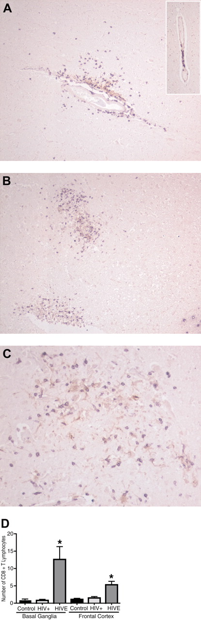 Figure 1. Accumulation of CD8+ T lymphocytes in the brain during HIVE. Increased number of CD8+ lymphocytes within the neuropil in HIVE brains (A) as compared with the seropositive patients without evidence of encephalitis (insert). Infiltrating CD8+ lymphocytes (purple) migrate toward HIV-1+ MPs (brown) of microglial nodule (B,C). The inset in panel A shows lymphocytes contained within the perivascular cuff in the HIV+ case. Human brain sections were double-immunostained with antibodies to CD8+ (purple, VIP substrate) and HIV-1 p24 (brown, DAB substrate). Original magnifications: panels A and B: ×100; panel C: ×200. (D) CD8+ lymphocytes were counted in basal ganglia and frontal cortex (white matter) of human brains (average of 10 consecutive 20 × fields). *P < .05 compared with HIV-seropositive and -seronegative controls. Error bars indicate standard error of the mean (SEM).