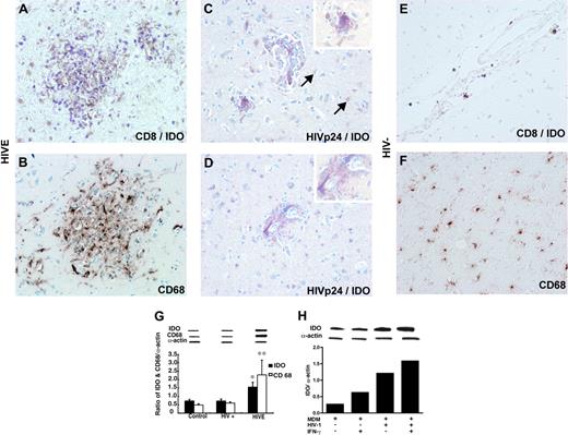Figure 2. IDO expression in human brain tissue with and without HIVE. Double immunostaining demonstrates accumulation of CD8+ T cells (purple) around IDO-positive cells (brown) in the microglial nodule in HIVE (A). CD68+ macrophages/microglia (brown) in the microglial nodule correspond to IDO-positive cells on serial section (B). IDO (brown) is mainly localized in HIVp24+ cells (purple) in microglia nodule (C) and perivascular cells (D). Occasional IDO-expressing astrocytes were seen in HIVE cases (arrows). Note the absence of purple stain in the cytoplasm of astrocytes. Fewer CD8+ T cells (E) and CD68+ cells (F) and lack of cells staining for IDO (E) are shown in HIV-negative control. Human brain sections were double-immunostained with antibodies to CD8+ and HIVp24 (purple, VIP substrate) and IDO (brown, DAB substrate;A,C-E) or CD68 (brown, DAB substrate; B,F). Original magnifications: panels A-D: ×200; inset, panels C and D: ×600. Western blot analysis for IDO and CD68 expression in brain homogenates from control (HIV-), HIV+, and HIVE cases. Representative immunoblots of CD68, IDO, and internal standard α actin, and ratios of IDO/α actin and CD68/α actin are shown (G). IDO expression detected by Western blot in uninfected or HIV-1-infected MDMs in vitro with or without IFN-γ stimulation (H).