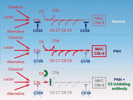 Schematic representation of the complement cascade reaction in healthy individuals, in patients with PNH, and in patients with PNH receiving the C5-inhibiting antibody. In humans the complement system consists of more than 30 plasma and cell-surface proteins. The complement system may be activated by 3 different pathways: the classic, lectin, and alternative pathways. The primary goal of the activation pathway is C3b deposition on the target cell, which is followed by the formation of the membrane attack complex (MAC) in the lytic pathway of complement activation, necessary for the lysis of the target. The deficiency of the surface proteins CD55 and CD59 leads to the uncontrolled lysis of PNH red cells by complement. The C5-binding antibody eculizumab blocks the lytic pathway of complement activation.