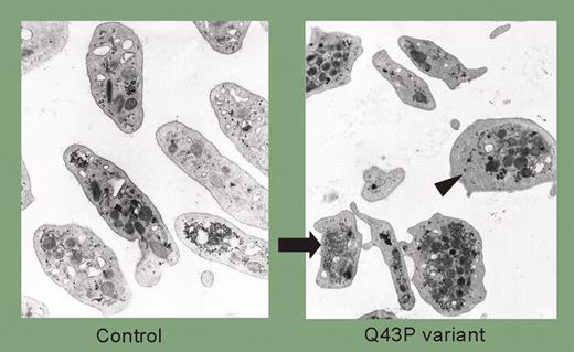 Electron microscopy of platelets of a healthy individual and a β1-tubulin Q43P variant carrier. Distrupted marginal band, cytoplasmatic clusters composed of abnormal membrane complexes, and organelle-free zones are present.