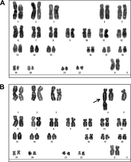 Figure 1. DAPI-banding analysis of MART-127-35–specific, hTERT-transduced CTL 4-TG. (A) DAPI-banded karyogram of a representative metaphase (n = 28) derived from CTL 4-TG at 2 months after hTERT transduction, indicating a normal 46, XX karyotype. (B) DAPI-banded karyogram of a metaphase derived from 4-TG at 10 months after hTERT transduction, showing a dicentric chromosome (arrow), consisting of a complete chromosome 4 fused to a centromere containing 5q, found in 1 cell of 24 cells analyzed.