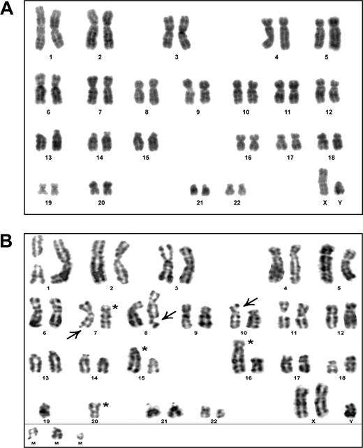 Figure 2. DAPI-banding analysis of HPV16 E711-20–specific CTL A9 and its hTERT-transduced counterpart CTL A9-TN. (A) DAPI-banded karyogram of a representative metaphase (n = 13) derived from untransduced A9, indicating a normal 46, XY karyotype. (B) DAPI-banded karyogram of a representative metaphase (n = 10) derived from A9-TN at 7 months after hTERT transduction, showing structural damage of chromosome arms 7q, 8q, and 10p (arrows) and rearrangements involving chromosomes 7, 15, 16, and 20 (asterisks). M indicates marker, unidentified chromosomes, or chromosome parts.
