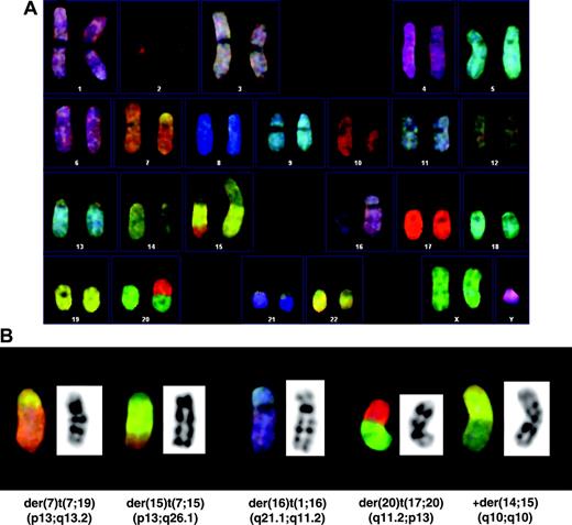 Figure 3. Spectral karyotyping (SKY) of hTERT-transduced HPV16 E711-20–specific CTL A9-TN. (A) SKY karyogram of a representative metaphase (n = 8) derived from A9-TN, 10 months after hTERT transduction, showing a 47, XY, +X, der(7)t(7;19)(p13;q13.2),+der(14;15)(q10;q10),–15, der(15)t(7;15)(p13;q26.1), der(16)t(1;16)(q21.1;q11.2), der(20)t(17;20)(q11.2;p13) karyotype containing chromosomal translocations. (B) Representative enlargements of the 4 indicated clonal translocations detected in 8 of 8 metaphases, and 1 nonclonal translocation detected in 5 of 8 metaphases, respectively, present at 10 months after hTERT transduction.