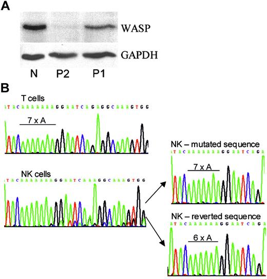 Figure 1. Western blot and WASP gene analyses. (A). Western blot. Shown are the PBMCs of a genetically normal person (N) and of P2 and P1 stained with rabbit antibodies to WASP C-terminal 15 amino acids8 or GAPDH. (B) Genomic DNA analysis. Shown are amplified WASP exon 4 regions of T cells and NK cells of P1 as well as 2 representative clones of his NK-cell DNA. Only the inherited 7 adenines were found for NK and T cells of the patient's brother, P2 (not shown). Only the 6-adenine sequence was found for normal NK and T cells (not shown).