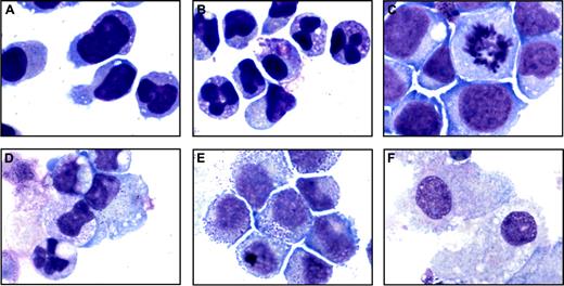 Figure 6. Morphologic changes induced by gefitinib in primary patient AML blasts. May-Grünwald Giemsa staining of primary patient M3-AML blasts (patient 1) containing the t(15;17) and trisomy 8 treated in vitro for 3 days with (A) 0.01% DMSO and (B) 5 μM gefitinib, primary patient M4-AML blasts (patient 7) treated in vitro for 4 days with (C) 0.01% DMSO and (D) 2.5 μM gefitinib, and primary patient M1-AML blasts (patient 8) containing trisomy 8 treated in vitro for 7 days with (E) 0.01% DMSO and (F) 10 μM gefitinib. Images were acquired with an Olympus BH-2 microscope, × 100/1.25 magnification under oil, an Olympus Q-Color 5 digital camera, and Adobe Photoshop CS version 8.0 software.