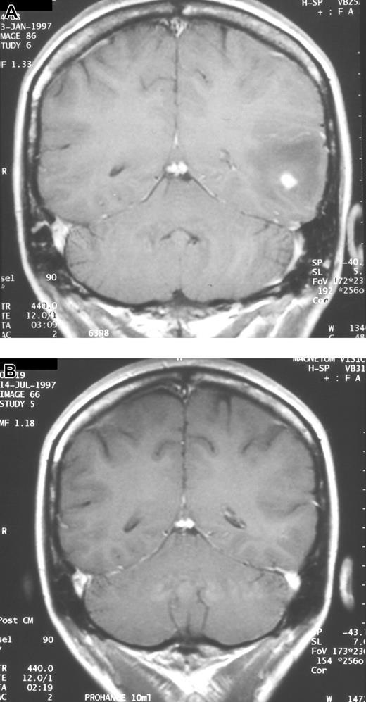Figure 1. Serial neuroradiologic studies in a patient with CNS aspergillosis. Coronal MRI scans showing complete resolution of a single brain abscess after 133 days of voriconazole therapy. (A) Prior to start of voriconazole. (B) After therapy.