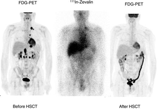 Figure 2. Response in patient with refractory relapsed DLBCL.