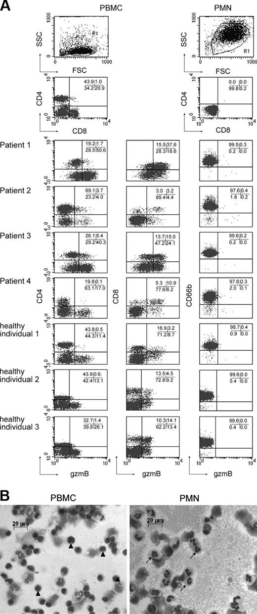Figure 7. GzmB is only expressed in fractions of CD4+ and CD8+ PBMCs, but not in CD66b+CD4-CD8- PMNs of 4 patients and 3 healthy individuals. (A) PBMCs and PMNs were isolated from 4 patients (1-4) and 3 healthy individuals and analyzed (FACSCalibur) by staining with either mAb to CD4 and CD8 (PBMCs and PMNs), or mAb to CD66b (PMNs), and subsequently with αhugzmB mAb (1:50) as described in “Materials and methods.” Numbers in graphs indicate the percentages of gated cells. (B) Similarly prepared PBMCs and PMNs from another individual showing a comparable phenotype as the healthy individuals mentioned in panel A were centrifuged on microscope slides and stained with May-Grünwald/Giemsa as described in “Materials and methods.” Arrowheads indicate mononuclear cells; arrows, polymorphonuclear leukocytes.