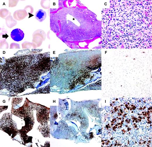 Figure 1. Peripheral blood and bone marrow findings before and after treatment with PKC 412. (A-F) Before treatment. (G-I) After treatment. (A) Circulating mast cell (arrow, left) and dysplastic nucleated red blood cell (arrowhead, right) in peripheral blood. Wright-Giemsa, 1000 ×. (B) Hypercellular bone marrow with aggregates of pale-staining mast cells surrounding a dilated sinus (*). Hematoxylin and eosin, 40 ×. (C) Whorled nodule of mast cells with characteristic clear cytoplasm including spindled forms. Hematoxylin and eosin, 400 ×. (D) Increased mast cells show a nodular and interstitial pattern in the bone marrow occupying approximately 70% marrow cellularity. Mast cell tryptase, 40 ×. (E) The majority of mast cells are highlighted by CD25 antibody. CD25, 40 ×. (F) Few numbers of CD34-positive blasts (∼5%) detected on bone marrow biopsy. CD34, 400 ×. (G) The posttreatment bone marrow shows a similar mast cell burden as seen prior to treatment. Mast cell tryptase, 40 ×. (H) A slight decrease in CD25-positive mast cells (∼40% of marrow cellularity) is noted after therapy. CD25, 40 ×. (I) Increased numbers of CD34-positive blasts (10%-20%) in bone marrow biopsy indicating progression of this patient's AHNDMD, MDS/MPD. CD34, 400 ×.