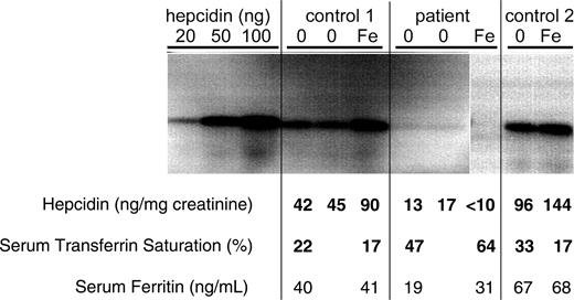 Figure 1. Urinary hepcidin levels in 2 controls and the proband, before and after ingestion of 80 mg iron as ferrous sulfate. Synthetic hepcidin standards (20, 50, and 100 ng) and urinary extracts equivalent to 0.5 mg creatinine were analyzed by sodium dodecyl sulfate-polyacrylamide gel electrophoresis (SDS-PAGE) and Western blotting with rabbit anti-human hepcidin antibody. 0 = urine collected before iron ingestion; Fe = urine collected 24 hours after iron ingestion. Measures of urinary hepcidin, serum transferrin saturation, and serum ferritin are given for each subject at the indicated test times.
