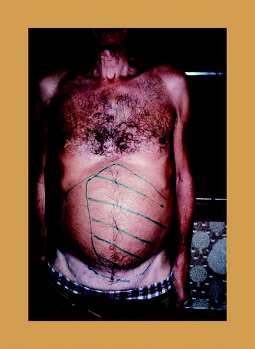 A patient with marked splenomegaly, agnogenic myeloid metaplasia (myelofibrosis with myeloid metaplasia).