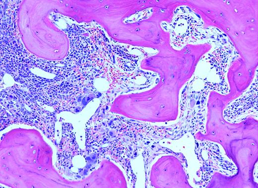 Myelofibrosis and osteosclerosis. Taken from patient shown.