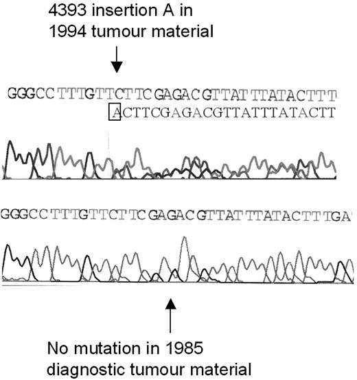 Figure 3. Development of an ATM mutation during disease progression. The ATM mutation 4393 insertion A was not present at the time of diagnosis of CLL in 1985 (bottom sequence) but was present in tumor material from 1994, after treatment with chlorambucil (top sequence). After the insertion of an additional adenine (A) nucleotide in one allele, the reading frames of the 2 alleles become out of line, resulting in a double sequence; one corresponding to the mutated and one corresponding to the unmutated allele.