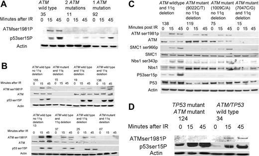 Figure 4. The effects of ATM mutations on the phosphorylation of ATM targets after ionizing irradiation. (A) CLL 35, with no ATM mutations, exhibited induction of ATM and p53 phosphorylation at 15 and 45 minutes after irradiation (IR). CLL 11, with 2 ATM mutations, shows almost no induction of the phosphorylation of either ATM or p53 at both time points after IR. CLL 92, with one ATM mutation, showed no induction in the phosphorylation of ATM but does exhibit some induction in the phosphorylation of p53 after IR. (B) CLLs 155 and 13, with wild-type ATM and no 11q deletion, had a normal ATM-dependent response. CLLs 15 and 7, with an 11q deletion (detected in 95% and 92% of cells respectively) and with an ATM mutation, revealed no ATM protein and no induction of p53 phosphorylation following IR. CLLs 19, 138, 37, and 25, with an 11q deletion (detected in 95%, 80%, 75%, and 97% of cells respectively) and a wild-type ATM allele, all exhibited induction of p53 phosphorylation comparable to wild-type tumors. (C) The induction of phosphorylation of multiple ATM targets is compared between tumor subtypes. Baseline levels of SMC1, Nbs1, and p53 proteins are shown below each phosphorylated protein and are comparable in all tumors. CLL 138, with loss of one ATM allele through an 11q deletion but with a remaining wild-type ATM allele, demonstrated induction of phosphorylation of ATM, p53, SMC1, and Nbs1 at early time points after IR, consistent with normal ATM activity. In contrast, CLLs 199 and 75, with one ATM allele with a missense mutation ATM and one wild-type ATM allele, showed impaired phosphorylation of ATM targets (most marked for CLL 199) despite high ATM protein levels, consistent with a potential dominant-negative effect. CLL 15, with loss of one ATM allele and a mutation in the remaining ATM allele, failed to phosphorylate any of the target proteins consistent with absent ATM protein. (D) CLL 34 had a normal ATM-dependent response. CLL 124, with a mutation in both the ATM and TP53 genes, showed absence of phosphorylation of ATM in response to IR, but increased baseline phosphorylation of p53 that increased further during response to IR.
