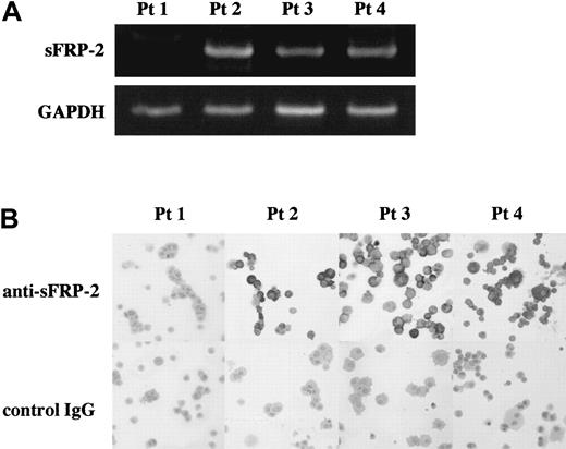 Figure 3. sFRP-2 is expressed by MM cells of patients with bone destruction. (A) Expression of sFRP-2 mRNA by MM cells isolated from patients with advanced bone disease was detected by RT-PCR. Total RNA (2 μg) extracted from primary cells was reverse transcribed, and 1 μL of the 20-μL reaction was used in PCR analysis for sFRP-2 and GAPDH mRNA. (B) The isolated MM cells were cytospun and stained with anti–sFRP-2 antibody or nonimmune IgG as described in “Patients, materials, and methods.” Cells were visualized under an Olympus BX50 microscope equipped with a UMplanFI 40 ×/0.75 objective lens (Olympus, Tokyo, Japan) to achieve an original magnification of 400 ×. Images were recorded with an Olympus SC35 CCD camera and Viewfinder Lite software (Pixera, Los Gatos, CA), and were digitally processed with Adobe Photoshop software (Adobe Systems, San Jose, CA).