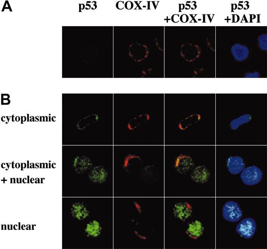 Figure 6. Representative p53 localization patterns in primary AML cells from case 14, which were treated with 10 μM Nutlin-3a for 3 hours. Cells were stained for p53 (green) and mitochondrial marker protein cytochrome c oxidase IV (red) and visualized by confocal microscopy. Nuclei were counterstained with DAPI (blue). Localization of p53 to mitochondria is indicated by the yellow-orange color in the merged images. (A) Untreated cells showed low levels of diffusely distributed p53. (B) After treatment, individual cells showed either cytoplasmic, cytoplasmic and nuclear, or nuclear accumulation of p53. In this case, a majority (75%) of cells showed cytoplasmic accumulation of p53, and the inhibitory effect of cycloheximide on loss of Δψm compared with Nutlin-3a alone was 26%. A preferential translocation of cytoplasmic p53 to mitochondria suggests that cytoplasmic p53 mediates apoptosis mainly at the level of mitochondria.