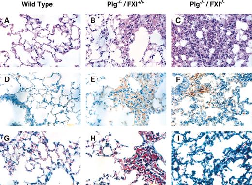 Figure 2. Photomicrographs of murine lung from wild-type, Plg–/–, and Plg–/–/fXI–/– mice. Shown are sections of lung from 6-week-old mice at × 40 magnification. Panels A, D, and G are from wild-type mice; B, E, and H from Plg–/–/fXI+/+ mice; and C, F, and I from Plg–/–/fXI–/– mice. (A-C) Hematoxylin and eosin. (D-F) Immunostaining with a polyclonal anti–murine fibrinogen/fibrin antibody. (G-I) Masson trichrome stain for collagen. The fields in panels B, E, and H were chosen to show a typical lung lesion in Plg–/– mice. These lesions are patchy, and most pulmonary architecture appears normal. In contrast, the leukocyte infiltration shown in panels C, F, and I for Plg–/–/fXI–/– is typically diffuse by age 6 weeks. Images were taken with an Olympus BX41 microscope (Olympus, Tokyo, Japan) fitted with a DP70 digital camera, using a 40 ×/1.7 NA UPlanF1 objective and Olympus DP controller software (version 1.2.1.108).