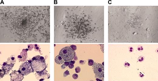Figure 1. Colonies formed under various conditions. Top and bottom panels show the appearance of colonies under an inverted microscope (ITM; Olympus, Tokyo, Japan) equipped with a camera module (DP50; Olympus) (objective lens, SPlan 4PL; numerical aperture, 0.13; magnification, × 4) and their constituent cells stained with May-Grünwald-Giemsa solution (microscope, BX51, Olympus; camera module, XC-003, Sony, Tokyo, Japan; objective lens, UPlan F1, Olympus; numerical aperture, 1.3; magnification, × 100), respectively. (A) A spontaneous GM colony in the culture of JMML BM cells without hematopoietic factors. (B) A GM colony in the culture of normal BM cells with 10 ng/mL GM-CSF. (C) A spontaneous G colony in the culture of JMML BM cells with 10 μM ZOL.