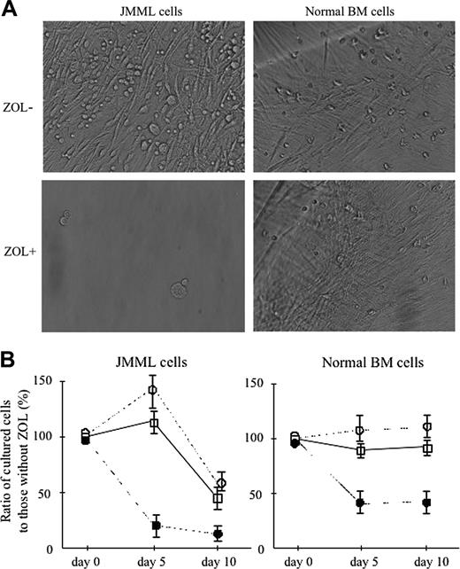 Figure 3. Effect of ZOL on the proliferation of JMML and normal BM cells in the suspension culture. (A) Phase microscopy of adherent cells developed from BM cells of a patient with JMML (case 4) and a healthy donor (case 3) at day 15 of suspension culture without and with 10 ng/mL ZOL (microscope, ITM2; camera module, DP50; objective lens, DPlan Ap10 UV, Olympus; numerical aperture, 0.4; magnification, × 40). A number of adherent cells were observed in the culture of JMML cells without ZOL, but their development was suppressed by the addition of ZOL. The growth of adherent cells in the culture of normal BM cells was not affected by the addition of ZOL. (B) The inhibition rate by 1, 10, and 100 μM ZOL in the proliferation of JMML and normal BM cells in the suspension culture without and with 10 ng/mL GM-CSF, respectively, at days 5 and 10. Each value indicates the mean ± SD calculated from the data in 3 patients with JMML and 3 healthy donors. □ indicates ZOL 1 μM; ○, ZOL 10 μM; •, ZOL 100 μM.