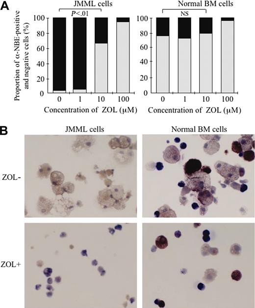 Figure 4. Effect of ZOL on the differentiation of JMML and normal BM cells in the suspension culture. (A) Effect of ZOL on the proportion of α-NBE–positive and –negative cells in the suspension culture of JMML and normal BM cells. Each value indicates the mean calculated from the data for 3 patients with JMML and 3 healthy donors. NS indicates not significant. ▪ indicates α-NBE-positive cells; ▦, α-NBE-negative cells. (B) Appearance of α-NBE–positive and –negative cells in the suspension culture of BM cells of a patient with JMML (case 4) and a healthy donor (case 5) without and with 10 ng/mL GM-CSF (microscope, BH2, Olympus; camera module, DP70, Olympus; objective lens, Span, Olympus; numerical aperture, 0.7; magnification, × 40). α-NBE–positive macrophages possess brown granules in their cytoplasm.