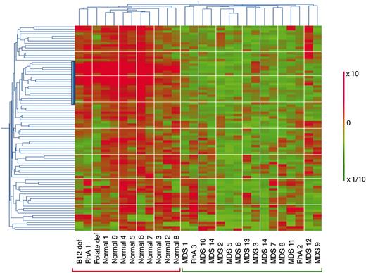 Figure 3. Hierarchic 2-way clustering of normal, MDS, and non-MDS anemia CD34+ cells using the predictive probe sets defined by neighborhood analysis. The initial data set of 14 low-risk MDS and 9 healthy controls was used in addition to that from 5 patients with non-MDS causes of anemia. Horiziontal clustering is by sample, and vertical clustering is by gene expression. Red bars indicate overexpression; green, underexpression; the vertical blue bar, the position of the lymphoid progenitor gene cluster.
