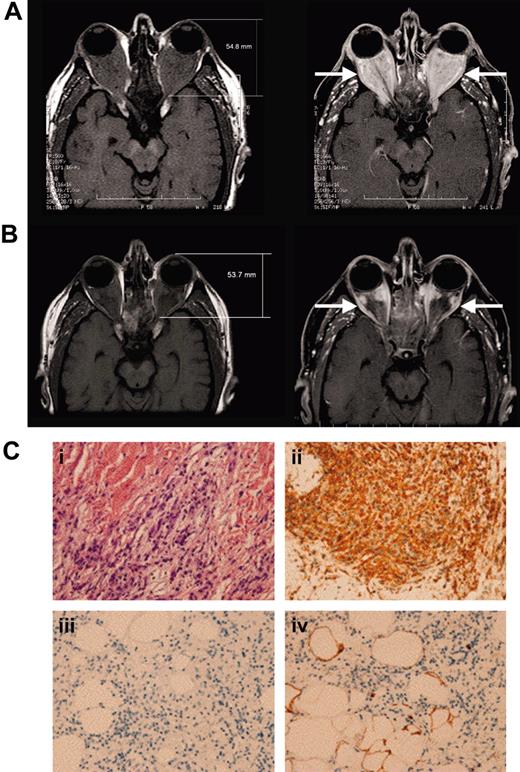 Figure 1. Retro-orbital and retroperitoneal disease in patient 1. (A) Before interferon-α, extensive retrobulbar soft tissue mass (arrows) is seen on the T1-weighted magnetic resonance imaging before (left) and after (right) gadolinium injection. (B) After 4 years of continuous interferon-α treatment, the extent of retrobulbar infiltration (arrows) continues to decrease substantially. (Ci) Perinephric adipose tissue reveals large foamy lipid-laden histiocytes with eosinophilic cytoplasm; (ii) staining positive for CD68, (iii) but staining negative for CD1a; and (iv) staining negative for S100 (< 5% positive). Images were acquired at a magnification of 200 × using a Nikon Microphot-FXA microscope (Nikon, Tokyo, Japan) fitted with a 20 × phase-contrast objective lens (PlanApo 20 ×/0.75 NA). Images were captured with a digital camera, model DP-70 (Olympus, Tokyo, Japan), using DP 12 image-acquisition software (Olympus), DP-70 (Olympus, Tokyo, Japan), using DP 12 image-acquisition software (Olympus), and image-processing was carried out using Microsoft PowerPoint (Microsoft, Redmond, WA).