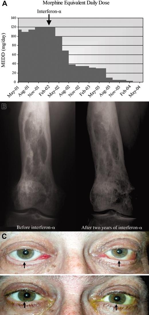 Figure 2. Response to interferon-α in patients 2 and 3. (A) Morphine equivalent daily dose (MEDD; mg/d) needed to manage pain before and after interferon-α therapy. Patient required 120 mg/d opioids before starting interferon-α. After 2 years, he no longer needs opioids. (B) Bone radiograph of the right femur reveals mixed osteosclerotic and osteolytic lesions before treatment. Ongoing improvement is seen after 2 years of treatment with interferon-α. (C) (Top) Bilateral exophthalmos with chemosis, engorged conjunctival vessels, and inferior scleral show (arrows) at presentation. Loss of eyelashes because of recent chemotherapy is noted. (Bottom) Exophthalmos, chemosis, and inferior scleral show (arrows) resolved after 2 years of interferon-α. Eyelashes have grown back.