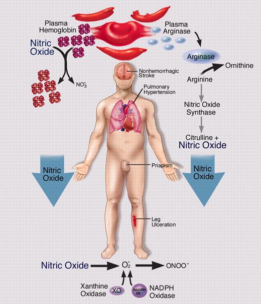 Hemolytic anemia. Illustration by Marie Dauenheimer.