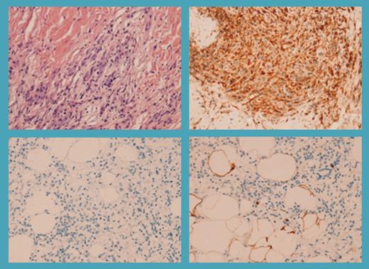 Retro-orbital and retroperitoneal disease in patient 1. See the complete figure in the article beginning on page 2992.