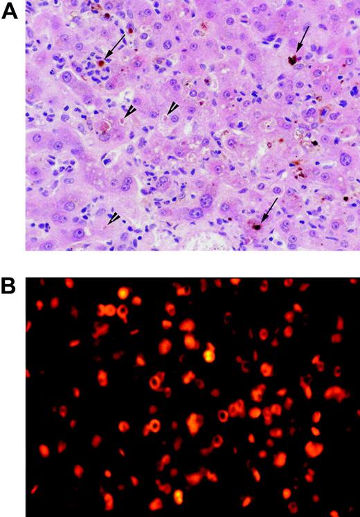 Figure 2. Photomicrographs of liver biopsy and bone marrow aspirate. (A) High-power photomicrograph of liver biopsy; the field shows a perivenular zone with canalicular cholestasis (arrowheads), vacuolar degeneration of hepatocytes, and prominent neutrophils and Kupffer cells, many of the latter containing protoporphyrin aggregates (arrows). Tissue was stained with hematoxylin and eosin and was examined through a Plan 40 ×/0.65 numerical objective lens, using an Olympus BX50 microscope fitted with an Olympus C-4040 digital camera (Olympus, Melville, NY). Images were acquired using Adobe Photoshop 5.0.2 (Adobe Systems, San Jose, CA). (B) Fluorescence microscopy of bone marrow aspirate showing intense red autofluorescence, indicating the presence of protoporphyrin in the cytoplasm of erythroid precursor cells and erythrocytes. Bone marrow smears were mounted in Vectashield (Alpha Laboratories, Eastleigh Hampshire, United Kingdom), and photomicrographs were taken with a Zeiss Axioplan microscope (Carl Zeiss, Welwyn Garden City, United Kingdom) using a tetramethylrhodamine isothiocyanate filter at 200 × total magnification using a 20 ×/0.50 objective lens.