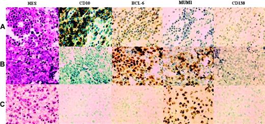 Figure 1. Immunohistochemical labeling patterns illustrating the 3 PCNSL immunoprofiles. (A) GCB: CD10+BCL-6+MUM1-CD138-. (B,C) The 2 predominant ABC patterns, respectively: activated GCB-cell CD10-BCL-6+MUM1+CD138- and non–GCB-cell CD10-BCL-6-MUM1+CD138-. Images were observed using a LEITZ DMR microscope (Leica, Wetzlar, Germany) with a 20 ×/0.70 numeric aperture objective, operating with a 3CCD color video camera (DXC.93OP; Sony, Tokyo, Japan). Image acquisition was performed using Analysis software (SIS Soft Imaging Software, Reutlingen, Germany).
