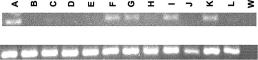 Figure 3. RT-PCR. RT-PCR of ZAP70 (top) and GAPDH (bottom). (A) Jurkat cell line; (B) Raji cell line; (C-E) CD19+ cells from the peripheral blood of 3 healthy donors; (F) primary T-ALL leukemic cells; (G-I) 3 E2A/PBX1+ leukemic cells; (J-L) 3 ALL1/AF4+ leukemic cells; and (W) negative control.