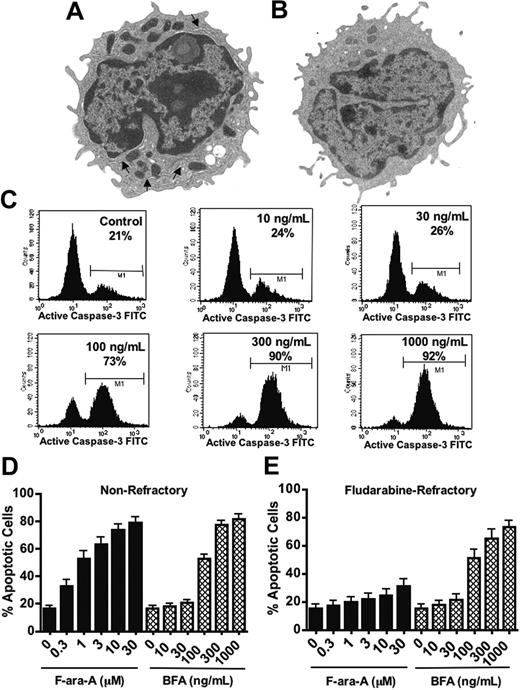 Figure 1. Brefeldin A induces apoptosis in fludarabine-refractory B-CLL cells. (A-B) Primary CLL cells exhibited a more extensive ER network than normal B lymphocytes. TEM was used to reveal the relative abundance of ER membranes (arrows) in primary CLL cells (A) and normal B lymphocytes (B). Original magnification, × 7500. Images were visualized using a JEM 1010 transmission electron microscope with a built-in camera and accelerating voltage of 80 KV (JEOL USA, Peabody, MA). A numeric aperture of 2.0 was used. (C-E) Fludarabine-refractory CLL cells were sensitive to BFA-induced apoptosis. CLL cells from 30 patients were treated in vitro with the indicated concentrations of fludarabine nucleoside (F-ara-A) or BFA for 48 hours. Drug-induced apoptosis was measured by flow cytometric analysis of activated caspase-3. Representative results are shown in panel C. The bar graphs in panels D and E show the percentage of cells with activated caspase-3 for nonrefractory patients (n = 15) and fludarabine-refractory CLL patients (n = 15), respectively. ▪ represent cells treated with F-ara-A; ⦾ depict cells treated with BFA. Error bars indicate standard error of the mean (SEM).