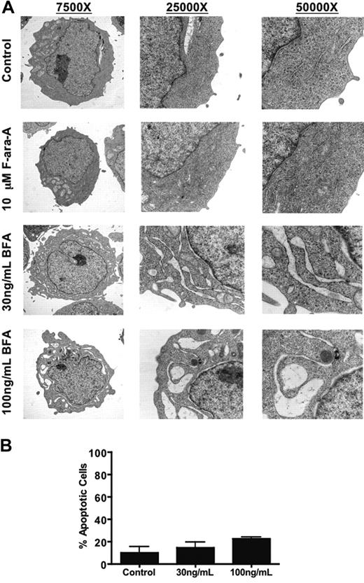 Figure 4. Brefeldin A causes severe dilation of ER membranes in primary CLL cells prior to the onset of apoptosis. (A) Primary CLL cells were treated with 10 μM F-ara-A or 30 ng/mL (107 nM) and 100 ng/mL (357 nM) BFA for 24 hours. Cells were fixed and ER morphology was analyzed by transmission electron microscopy as described in “Patients, materials, and methods.” Original magnification of all images is indicated. Images were obtained as for Figure 1A-B. (B) Brefeldin A induces changes in ER morphology prior to the onset of appreciable apoptosis. A portion of BFA-treated primary CLL cells used for transmission electron microscopy analysis was fixed for active caspase-3 staining to quantitate the percentage of apoptotic cells. Only a minor portion of brefeldin A-treated cells stained positively for caspase-3 at this time point (24h). Error bars indicate the standard deviation (n = 4).