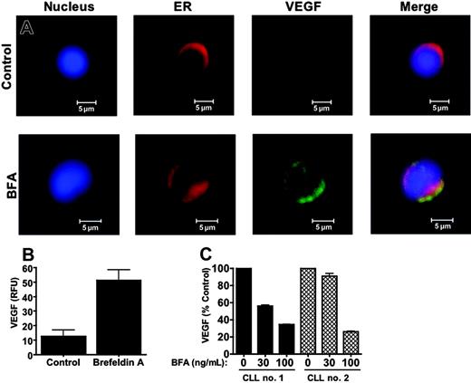 Figure 5. Brefeldin A inhibits VEGF secretion. (A) Brefeldin A treatment caused VEGF to accumulate in the ER of primary CLL cells. CLL cells were treated with 100 ng/mL BFA for 24 hours. Cells were cytocentrifuged onto glass slides and fixed as described in “Materials and methods.” Fixed cells were stained with an antibody against VEGF and markers for the ER (calreticulin) and nucleus (To-Pro-3). The fluorescence of stained cells was visualized by confocal microscopy. Images were obtained as for Figure 3A. (B) Quantitation of the brefeldin A-induced increase in VEGF immunofluorescence. The intensity of immunofluorescence of multiple cells was quantitated for the control and BFA-treated cells using Optimas software as described in “Patients, materials, and methods” (n = 8). Error bars indicate the SD. RFU indicates relative fluorescence units. (C) Brefeldin A causes a dose-dependent reduction in VEGF secretion. Primary CLL cells were treated with 30 and 100 ng/mL BFA for 16 hours. Secreted levels of VEGF were quantitated in the culture medium by ELISA as described in “Patients, materials, and methods.” Bars represent the average of 2 assays, which varied by less than 10%.