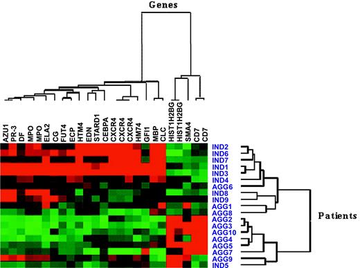 Figure 1. Hierarchical clustering using microarray expression measures on 20 most significantly different genes, represented by 25 probe sets, in 19 patient samples. Ind indicates indolent CML; Agg, aggressive CML. Red squares indicate genes that were overexpressed, and green squares indicate genes that were underexpressed. Note that in 4 cases individual genes were studied with more than one probe set.