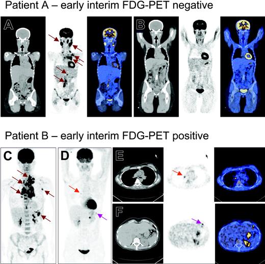 Figure 1. PET and PET/CT images of 2 patients with stage III Hodgkin lymphoma. Panels A-B and E-F are PET/CT images with CT, PET, and fusion images from left to right. Panels C-D are PET images. Patient A initially had involvement of cervical regions, left axilla, mediastinum, and the para-aortic glands in retroperitoneum (A, brown arrows). After 2 cycles of chemotherapy, CT still showed cervical and mediastinal swelling, while PET showed only physiologic uptake. Patient A is now in the fourth year of complete remission. Patient B initially had involvement of the left base of the neck, left axilla, mediastinum, and the spleen (C, brown arrows). After 2 cycles of chemotherapy (D-F), there was still some pathologic FDG uptake in the mediastinum (red arrows) and upper abdomen (pink arrows). The patient was considered in remission after treatment ended but later relapsed in the mediastinum.