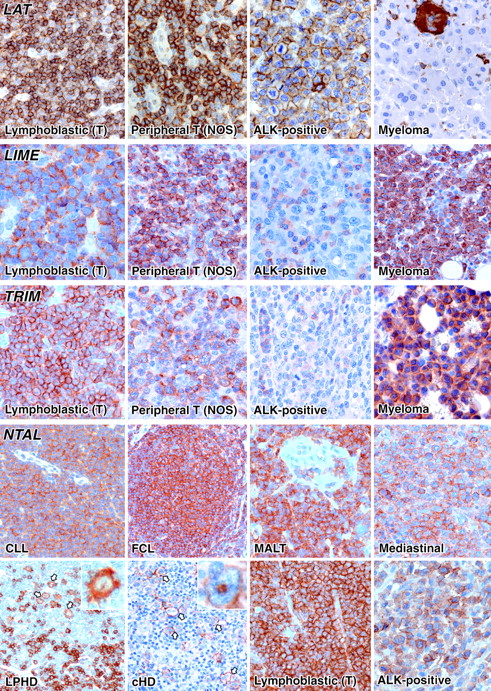 Figure 2. Representative examples of lymphoma subtypes immunostained for T-cell-associated transmembrane adaptor proteins LAT, LIME, and TRIM and the B-cell-associated molecule NTAL. Note cases of T-lymphoblastic lymphoma expressing these markers and cases of ALK+ anaplastic large-cell lymphoma (ALCL) that are negative for LIME and TRIM. The reactivity of cases of myeloma for LIME and TRIM is also shown. In contrast, LAT is not expressed in this tumor (note positive megakaryocyte). NTAL is expressed in B-cell lymphomas, and examples are also shown of 2 NTAL+ T-cell neoplasms (lymphoblastic and ALK+). In Hodgkin disease, NTAL expression is shown in a case of lymphocyte-predominant Hodgkin disease (LPHD) and in the classic subtype (arrows indicate lymphocytic and histiocytic cells and Reed-Sternberg cells). Image acquisition was performed as described for Figure 1.