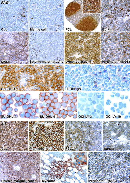 Figure 3. Immunostaining of PAG and SIT in neoplastic lymphoid cells. PAG is present in cases of both B- and T-cell neoplasia. Note the 2 cases of DLBCL, one positive and one negative. Two DLBCL-derived cell lines of GC type express PAG, whereas the other 2 (of “activated” subtype) are negative. SIT expression is shown in a variety of B-cell neoplasms, including a case of myeloma. Image acquisition was performed as described for Figure 1.