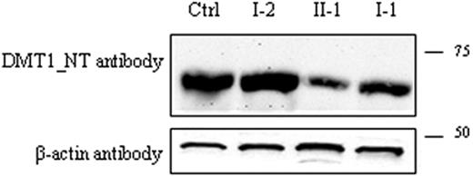 Figure 4. Detection of DMT1 protein in PBMCs. Total PBMC extracts were prepared as described: 80 μg total protein was loaded into each lane and was separated by SDS-PAGE on a 10% acrylamide gel followed by transfer to PVDF membranes. Membranes were incubated with anti-DMT1-NT antibody (A) and with β-actin antibody as an internal loading control (B). Samples in the different lanes are indicated. Sizes (in kDa) are on the right.