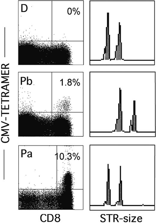Figure 2. CMV-specific, tetramer-positive T cells in patient 13—a recipient of a T-cell-replete graft from a CMV-negative donor—are of donor origin. Data show the percentages of tetramer-positive cells in the donor (D) and the patient before (Pb) and after (Pa) transplantation and the corresponding STR analysis for the locus D11S554.