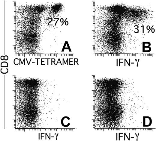 Figure 4. CMV-specific T cells of recipient origin produce IFN-γ after stimulation with pp65-transfected, EBV-transformed B-cell lines. (A) Percentages of HLA-A*0101/YSEHPTFTSQY-tetramer positive cells at day 59. IFN-γ production by CD8+ lymphocytes in the same sample cultured overnight with HLA-A*0101-positive EBV cells transduced with GFP and pp65 (B), without stimulator cells (C), or with EBV cells transduced with GFP alone (D). Results are expressed as percentages of CD8+ cells with gates on lymphocytes (scatter) and GFP negativity (fluorescence 1) to exclude the antigen-presenting cells.