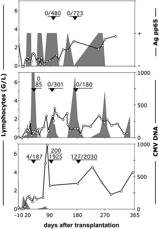 Figure 5. Reconstitution of CMV-specific, tetramer-positive cells and the occurrence of CMV-viremia in recipients of HSC grafts from CMV-negative donors. Top panel: patient 11. Middle panel: patient 12. Bottom panel: patient 13. ○ indicates number (G/L) of lymphocytes. Fractions in the graphs show the number per milliliter of tetramer-positive/CD8+ T lymphocytes at the moment indicated by arrowheads. Shaded areas represent the viral load expressed as either positive or negative for the pp65 antigen or as number of viral copies per milliliter of plasma.